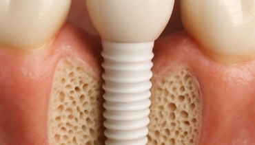 Impianti in ceramica