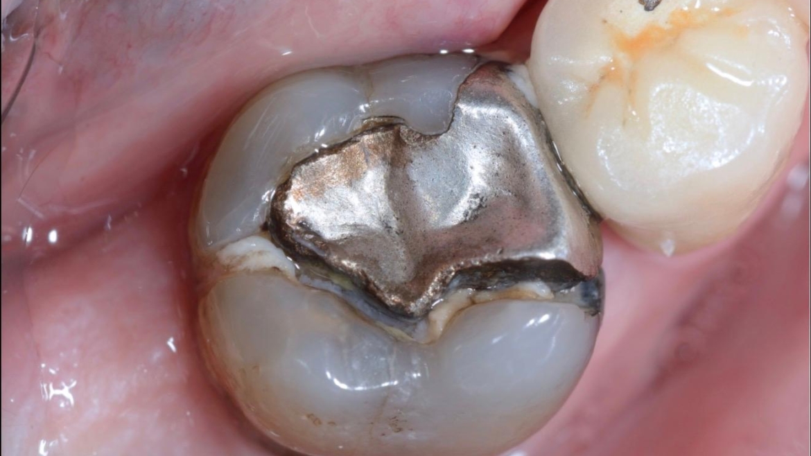 Guerra Alle Otturazioni in Amalgama