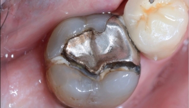 Guerra Alle Otturazioni in Amalgama